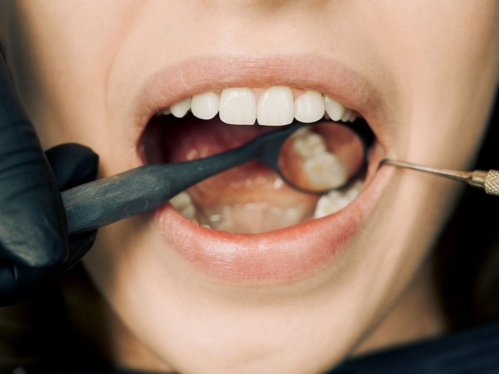 A close-up dental examination of the gum around a single tooth
