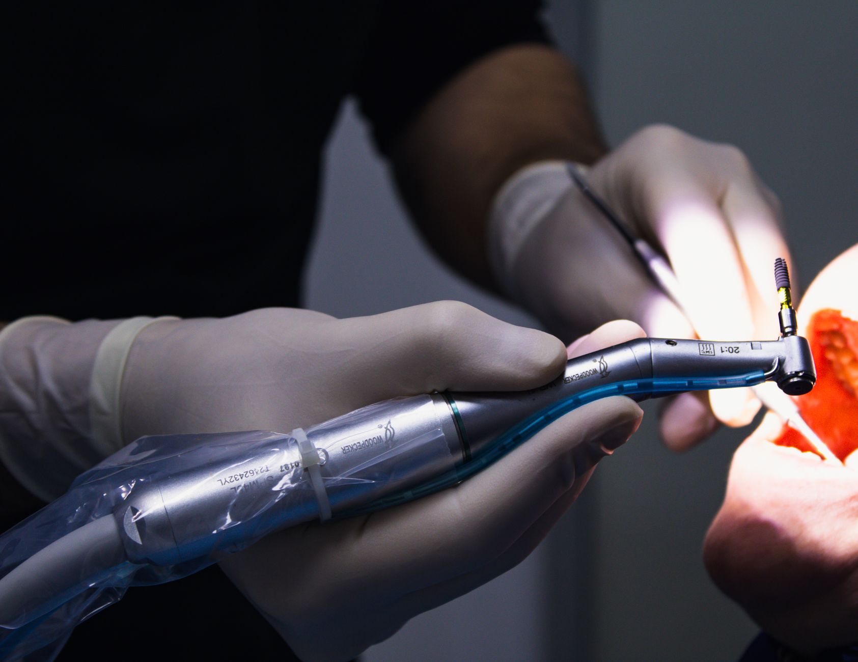 A dentist working on a back tooth with a handpiece during a filling appointment