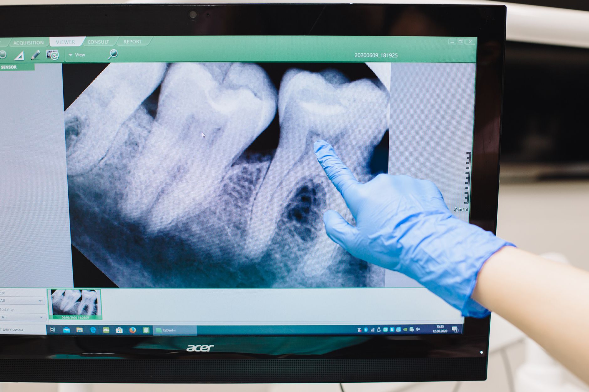 Dentist pointing to a tooth on a dental X-ray displayed on a screen
