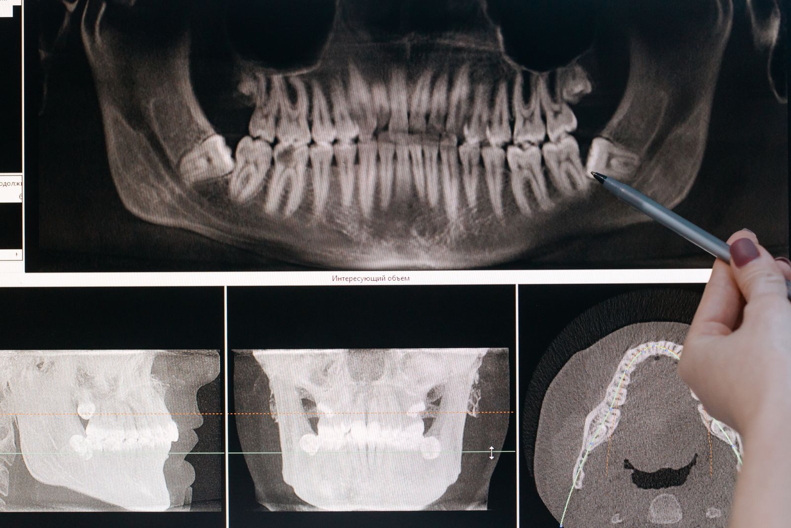 A dental X-ray of teeth on a screen, the kind used to plan a root canal on a crowned tooth