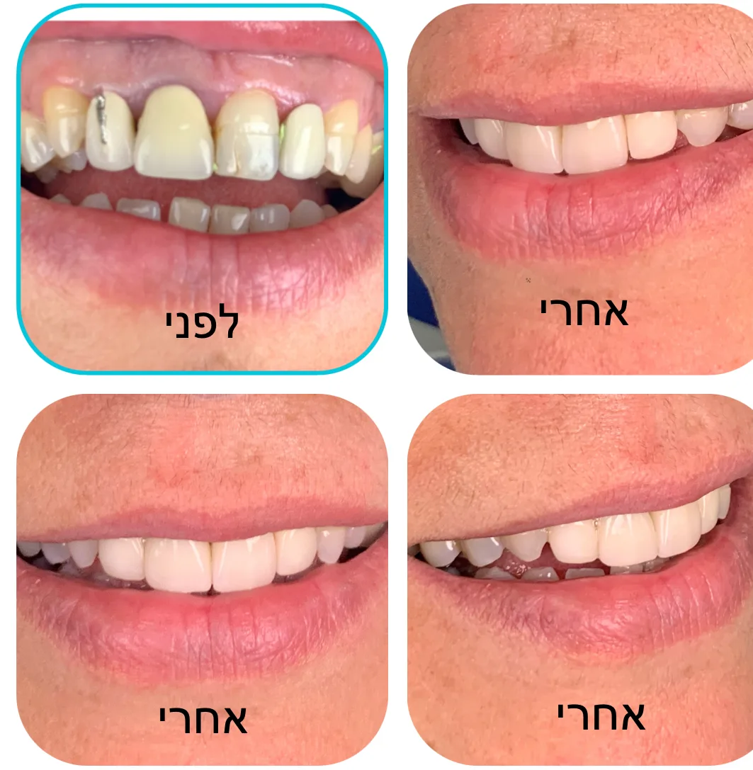 Before and after panels: broken and missing upper front teeth, rebuilt.