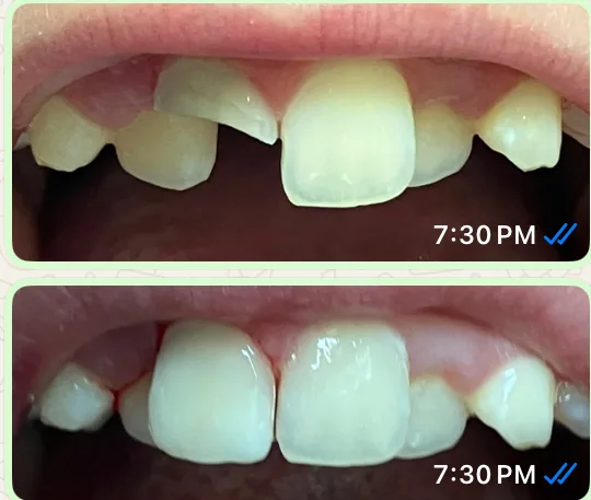 Before and after: chipped upper front teeth rebuilt.
