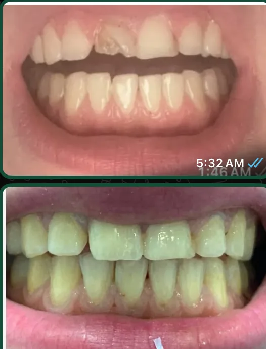 Before and after: uneven, worn upper front teeth restored to an even edge.
