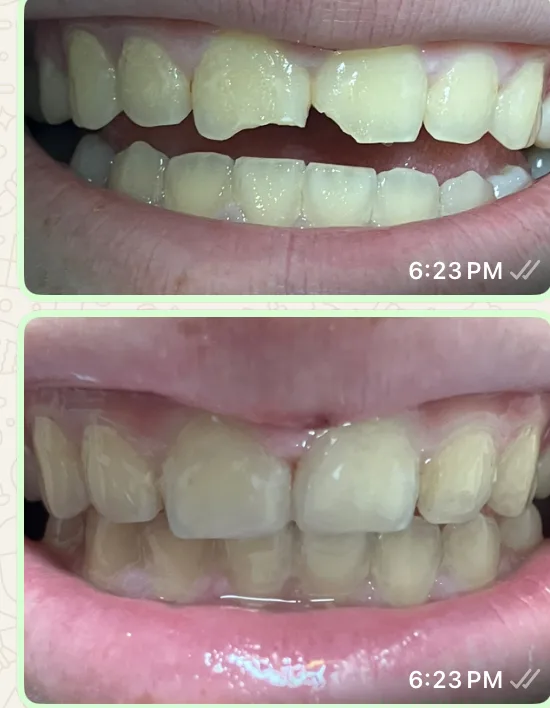 Before and after: a chipped upper front tooth rebuilt at the clinic.