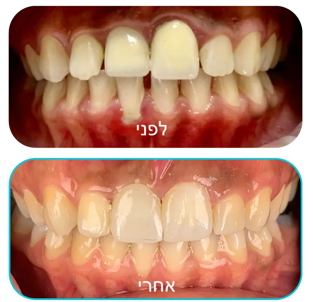 Before and after: a damaged upper front tooth restored with a crown matched to the neighbouring teeth.