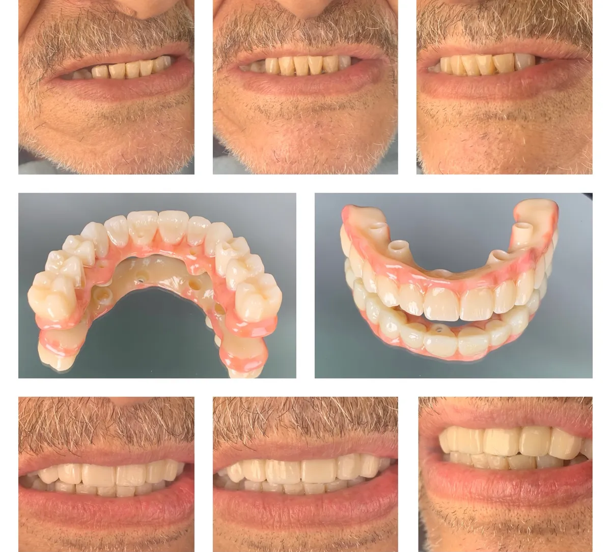 Before and after panels of a full-mouth reconstruction, with the finished prosthesis shown alongside.