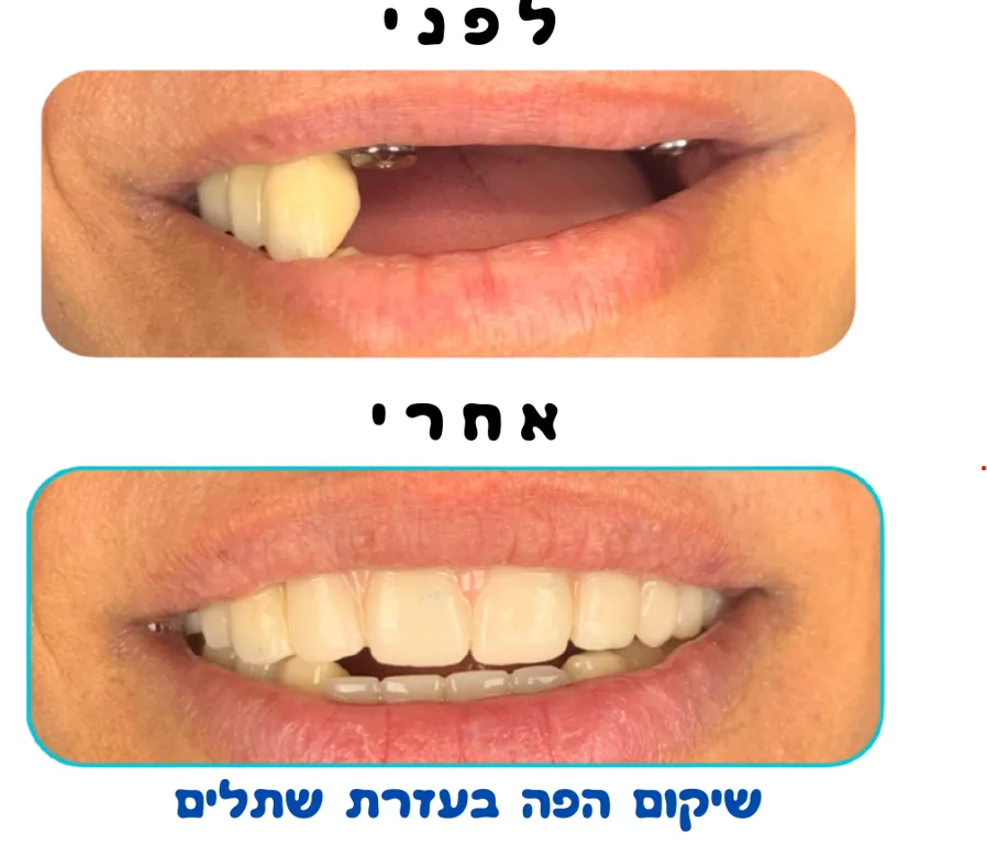 Before and after: missing back teeth restored, labelled by the clinic as mouth rehabilitation using implants.
