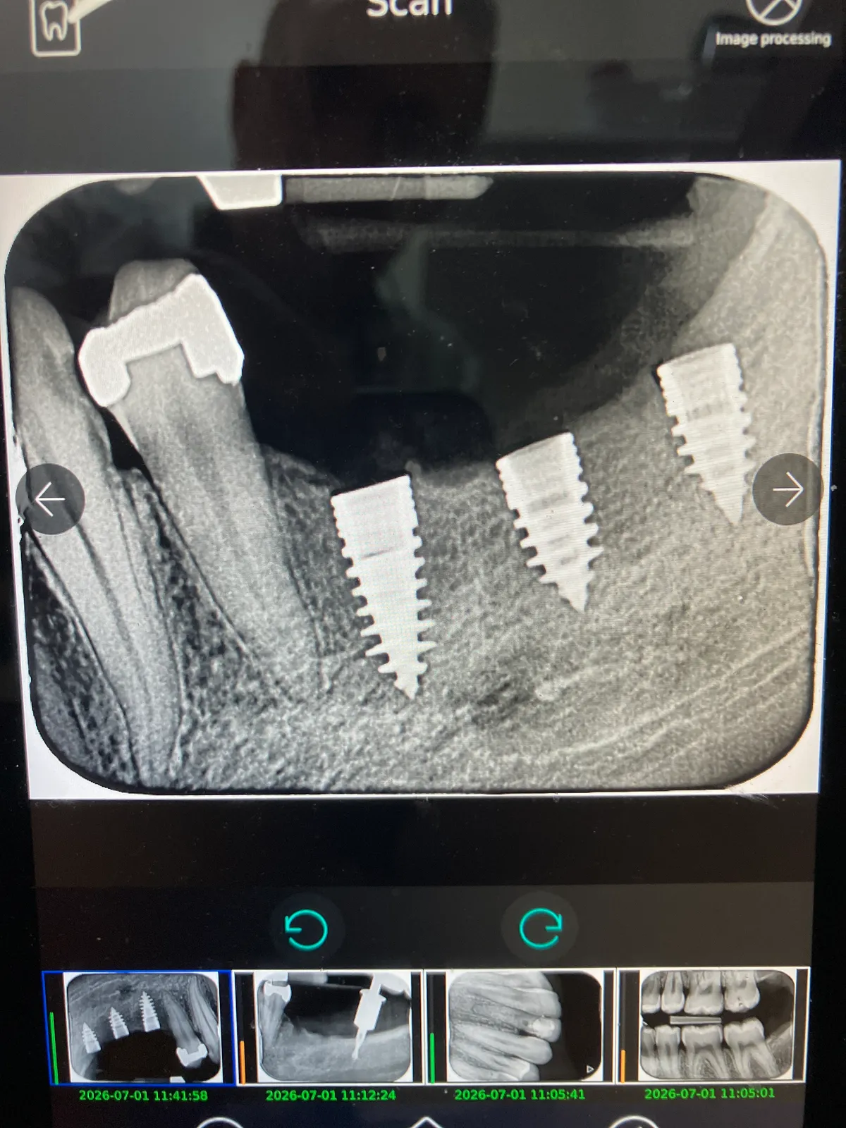 X-ray showing dental implants placed in the jaw next to a natural tooth.