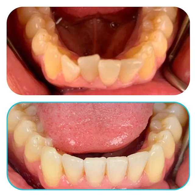 Before and after: crowded lower front teeth with build-up, cleaned and treated.