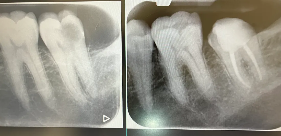 Two X-rays side by side: a back tooth before treatment, and the same tooth after its canals were filled.