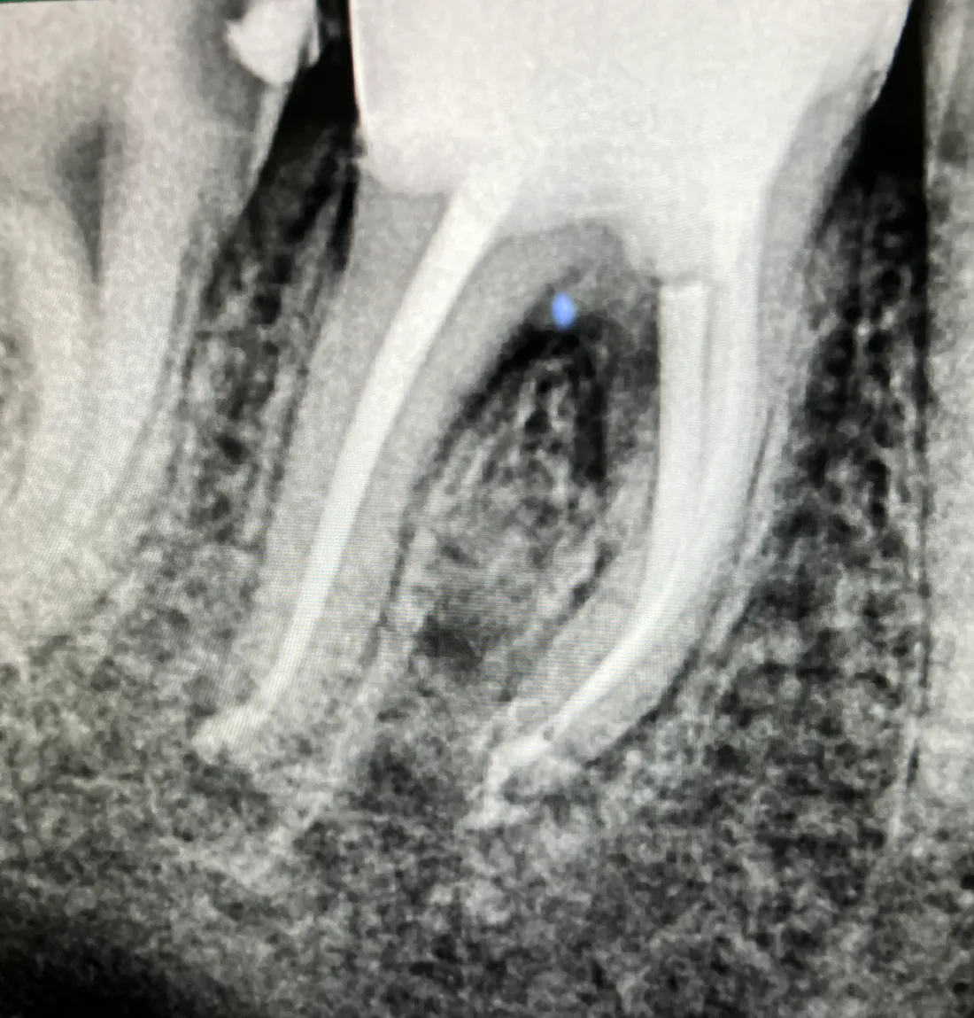 Root canals, with a gentle touch.