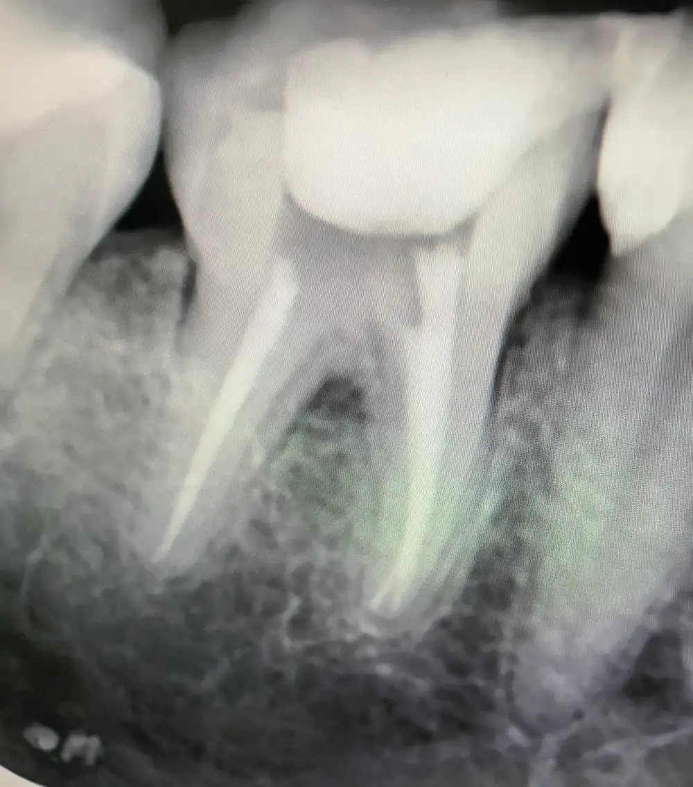 X-ray of a lower molar with both root canals filled to the tip.
