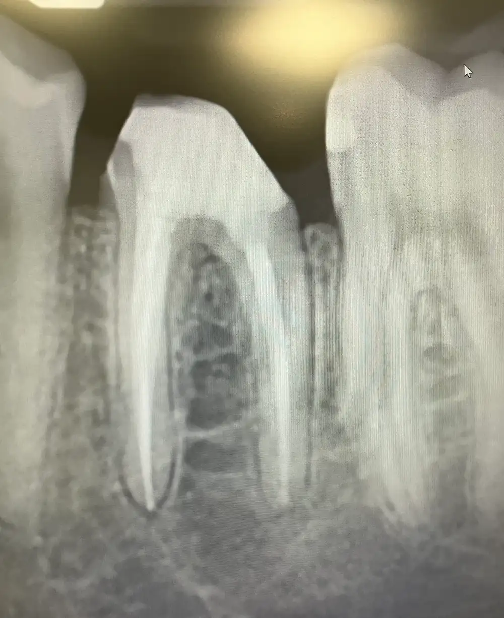 X-ray of a lower back tooth with its root canals filled.