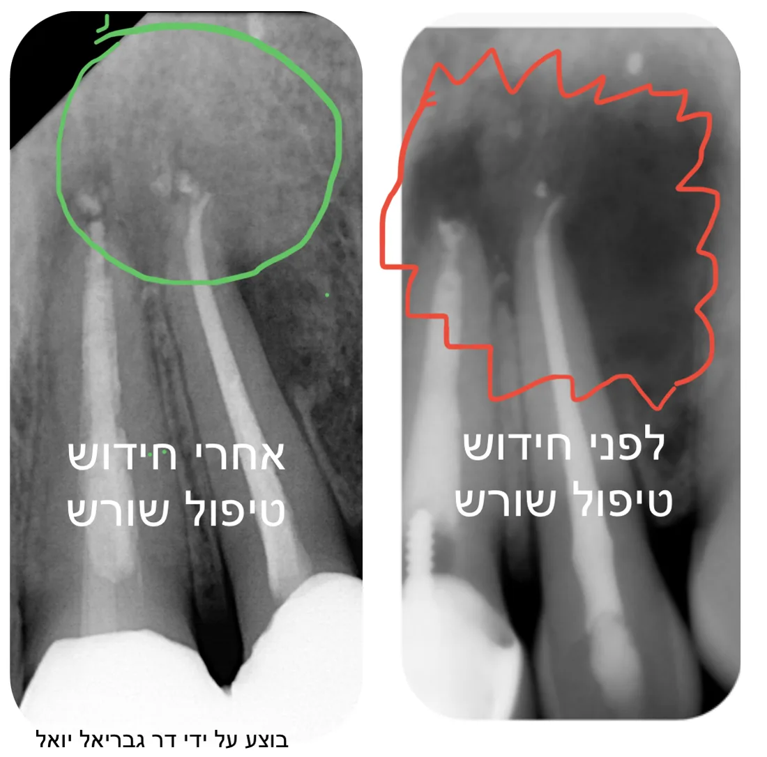 צילומי רנטגן לפני ואחרי חידוש טיפול שורש, עם סימון האזור שטופל.