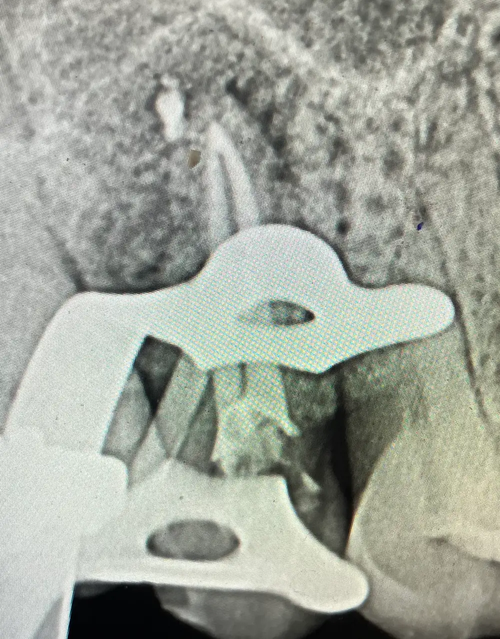 X-ray taken during treatment, with the rubber dam clamp visible around the tooth.