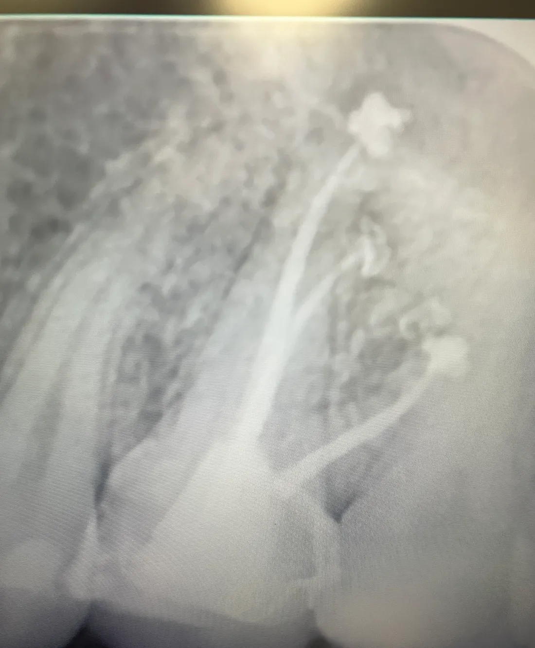 X-ray of an upper molar after root canal treatment.