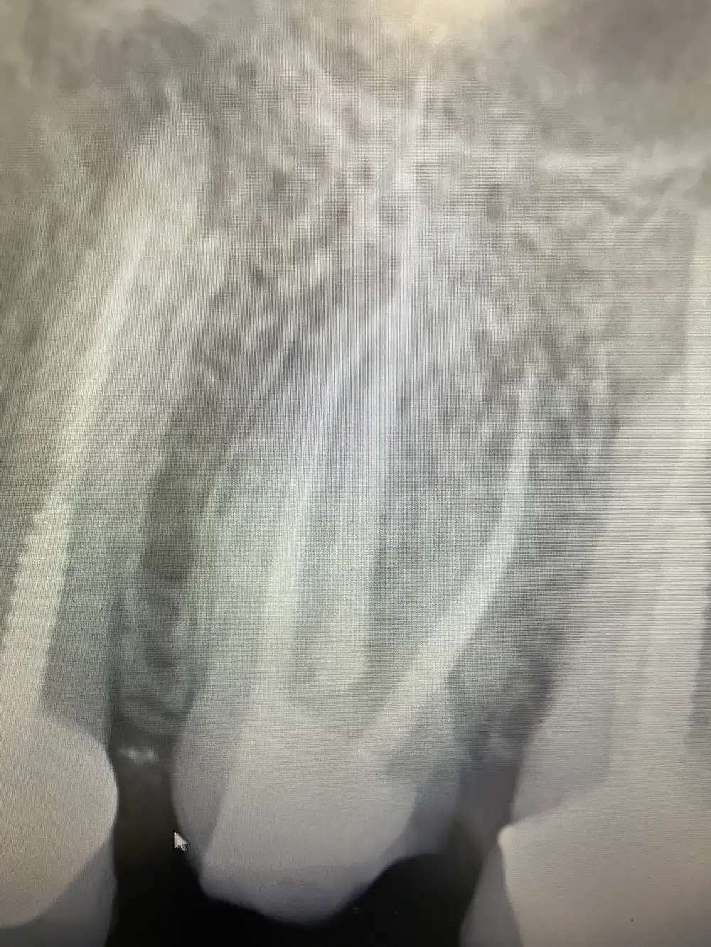X-ray of upper front teeth after root canal treatment.