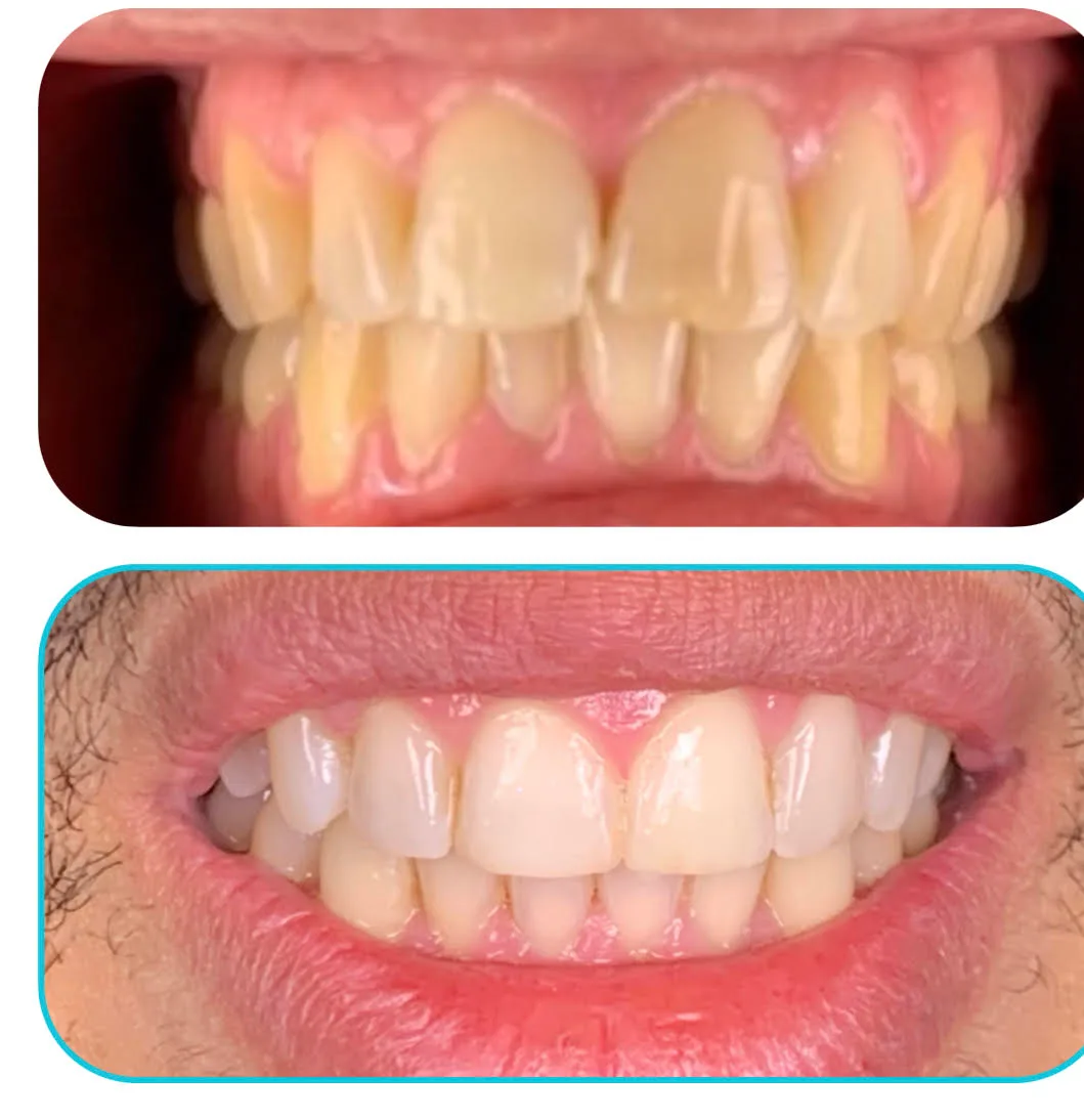 Before and after: upper and lower teeth restored.