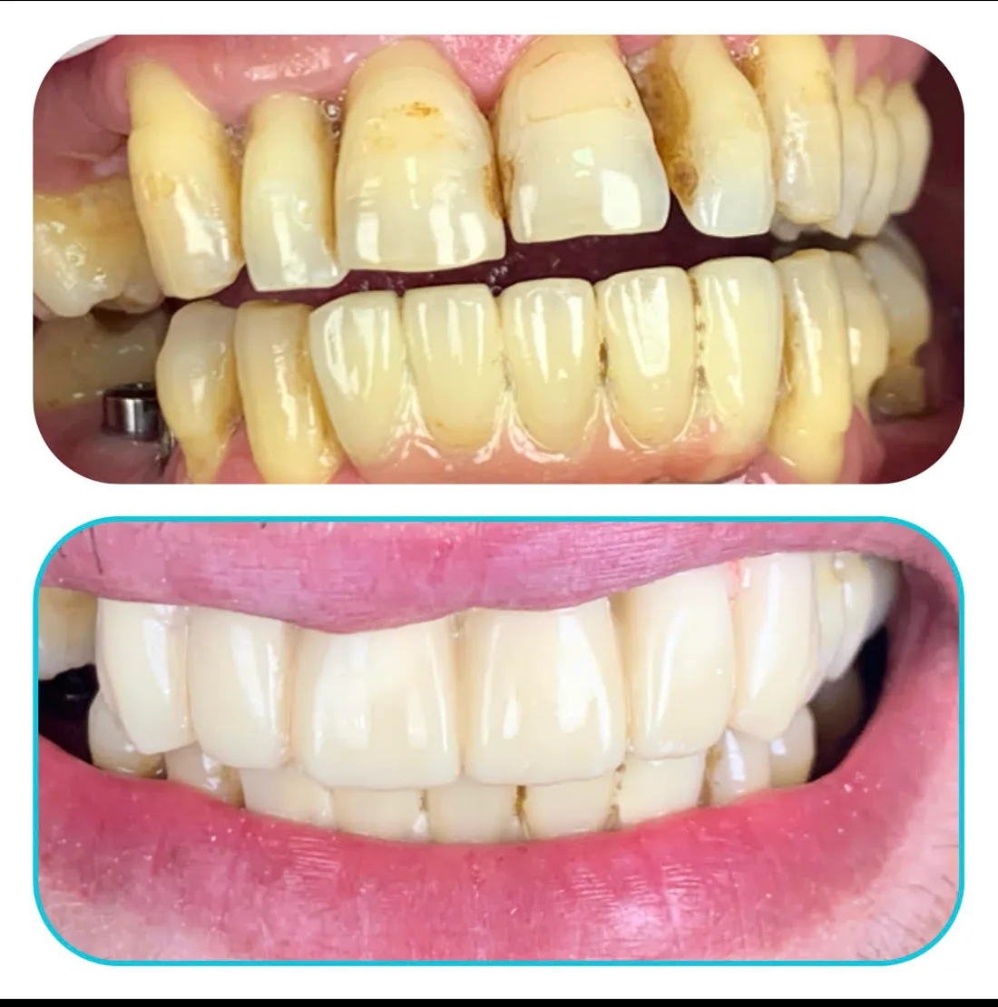 Before and after: heavily worn and stained teeth, restored.
